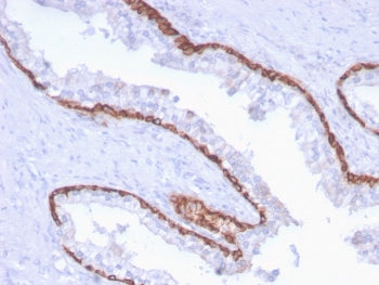 IHC staining of FFPE human prostate carcinoma with CK15 antibody (clone KRT15/2959). HIER: boil tiss