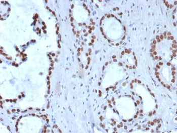 IHC staining of FFPE human prostate carcinoma tissue with Transducin-like enhancer protein 1 antibod