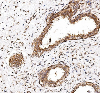 IHC staining of FFPE human breast cancer with CALCOCO2 antibody. HIER: boil tissue sections in pH8 E