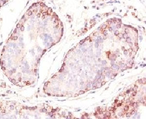 IHC: Formalin-fixed, paraffin-embedded human testicular carcinoma stained with MAGE-1 antibody (clon