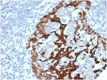 IHC staining of FFPE human prostate tissue with Cytokeratin 6A antibody (clone KRT6/3997R). HIER: bo
