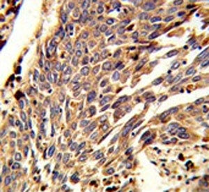 IHC testing of FFPE human lung carcinoma tissue with ARPC1B antibody. HIER: steam section in pH6 cit
