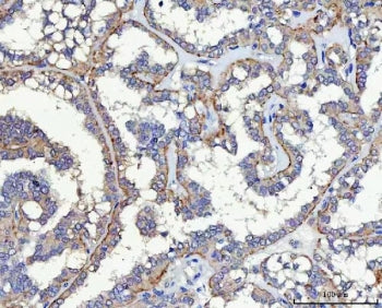 IHC staining of FFPE human thyroid cancer tissue with HP59 antibody. HIER: boil tissue sections in p
