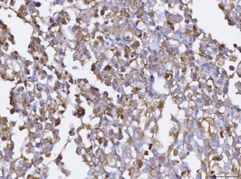 IHC staining of FFPE human pancreatic cancer tissue with BCAT1 antibody. HIER: boil tissue sections 