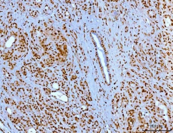IHC staining of FFPE human pancreatic ductal adenocarcinoma tissue with YY1 antibody. HIER: boil tis