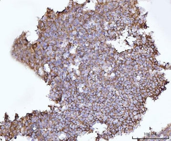IHC staining of FFPE human lymphoma tissue with Synaptosomal-associated protein 23 antibody. HIER: b