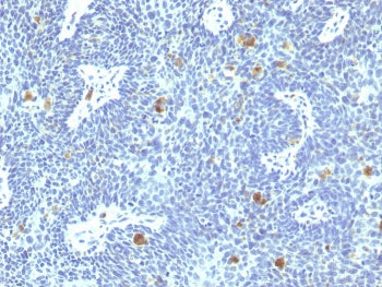 IHC staining of FFPE human cervix with HPV-16 E6 antibody. HIER: boil tissue sections in pH 9 10mM T