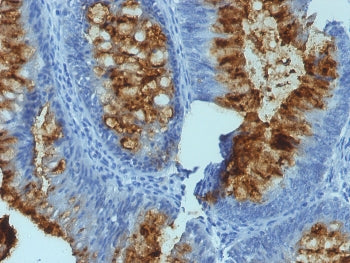 IHC staining of FFPE human colon carcinoma with FUT3 antibody (clone SPM194).