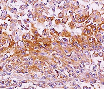IHC testing of melanoma tissue stained with Melanoma antibody (NKI-beteb). HIER: boil tissue section