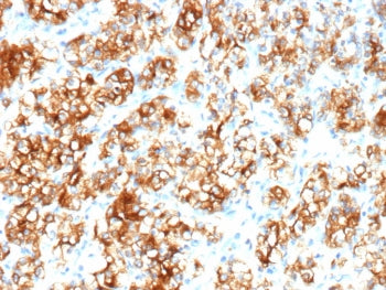 IHC staining of FFPE human renal cell carcinoma tissue with recombinant Carbonic Anhydrase 9 antibod