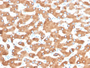 IHC staining of FFPE human liver carcinoma in colon with Haptoglobin antibody (clone HP/3832). HIER: