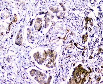 IHC staining of FFPE human breast cancer with CDA antibody at 1ug/ml. HIER: boil tissue sections in 