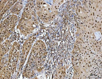 IHC staining of FFPE human laryngeal squamous cell carcinoma tissue with Protein arginine N-methyltr
