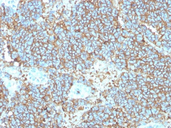 IHC staining of FFPE human Ewings sarcoma with recombinant CD99 antibody (clone rMIC2/3317). HIER: b