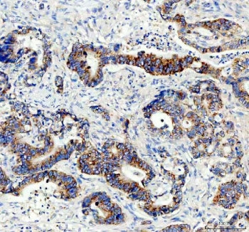 IHC staining of FFPE human stomach cancer tissue with AMACR antibody. HIER: boil tissue sections in 