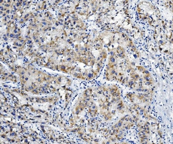 IHC staining of FFPE human liver cancer with ALDH6A1 antibody. HIER: boil tissue sections in pH8 EDT