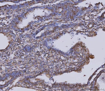 IHC staining of FFPE human cervical cancer tissue with Malate dehydrogenase 2 antibody. HIER: boil t