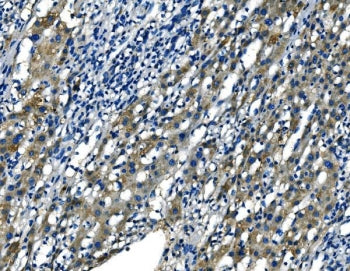IHC staining of FFPE human liver cancer tissue with Fibroblast growth factor 4 antibody. HIER: boil 