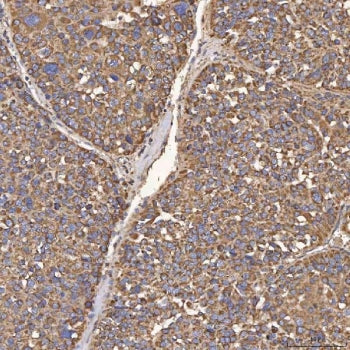IHC staining of FFPE human liver cancer tissue with HSD11K antibody. HIER: boil tissue sections in p