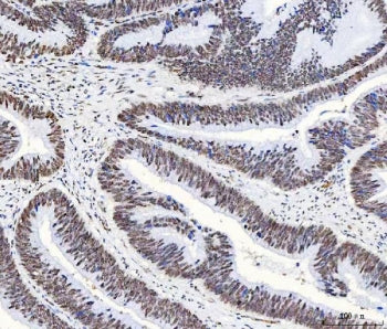IHC staining of FFPE human colorectal adenocarcinoma tissue with hnRNP H antibody. HIER: boil tissue