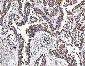 IHC staining of FFPE human breast cancer tissue with MOCS1 antibody. HIER: boil tissue sections in p
