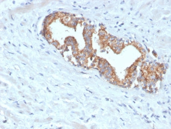 IHC testing of FFPE human prostate carcinoma with recombinant AMACR antibody. Required HIER: steam s