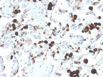 IHC staining of FFPE human lung adenocarcinoma with Napsin A antibody (clone NAPSA/3305). HIER: boil