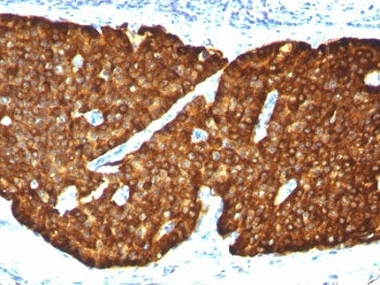 IHC: Formalin-fixed, paraffin-embedded human pheochromocytoma stained with Chromogranin A antibody (
