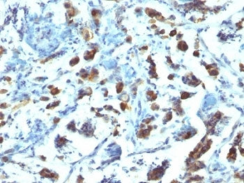 IHC: Formalin-fixed, paraffin-embedded human gastric carcinoma stained with anti-MUC3 antibody (SPM2