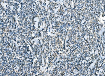 IHC staining of FFPE human lymphoma tissue with C-C chemokine receptor type 2 antibody. HIER: boil tissue sections in pH8 EDTA for 20 min and allow to cool before testing.