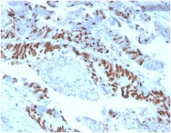 IHC staining of FFPE human colon carcinoma tissue with MCM2 antibody (clone MCM2/3678). HIER: boil t