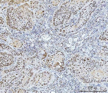 IHC staining of FFPE human laryngeal squamous cell carcinoma tissue with FEN1 antibody. HIER: boil t