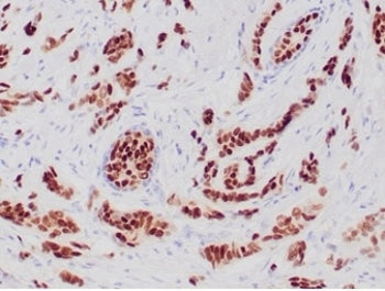 IHC staining of FFPE human breast carcinoma tissue with recombinant Progesterone Receptor antibody (