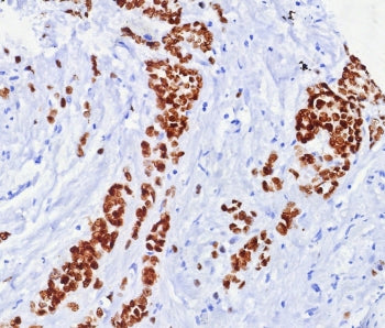 Formalin fixed paraffin embedded human breast carcinoma tissue with ER alpha antibody (clone ESR1/74