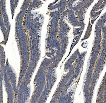 IHC staining of FFPE human rectal cancer with Synaptic vesicle glycoprotein 2A antibody. HIER: boil 