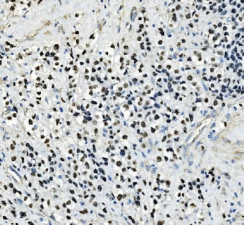 IHC staining of FFPE human testicular cancer tissue with AP2 gamma antibody. HIER: boil tissue secti