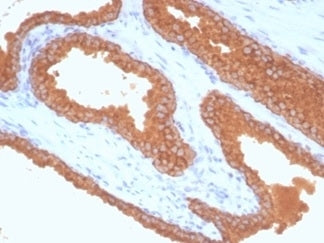 IHC staining of FFPE human prostate carcinoma tissue with recombinant Prostate Specfic Antigen antib
