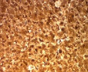 IHC: Formalin-fixed, paraffin-embedded human hepatocellular carcinoma stained with Arginase antibody