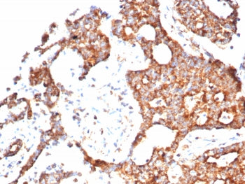 IHC staining of FFPE human prostate carcinoma tissue with PTEN antibody (clone PTEN/7344) at 2ug/ml.