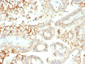 IHC staining of FFPE human kidney carcinoma tissue with B7-H3 antibody (clone B7H3/4313) at 2ug/ml. 
