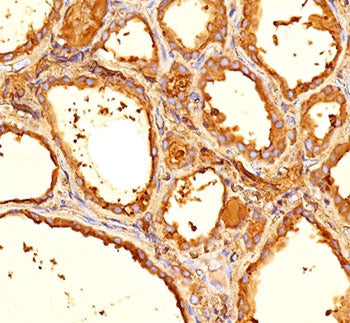 IHC staining of human thyroid tissue with Thyroglobulin antibody (clone 6E1).