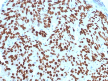 IHC staining of FFPE human prostate carcinoma with NKX3.1 antibody (clone NKX3.1/2576). HIER: boil t