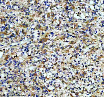 IHC staining of FFPE human glioma tissue with CAMK2 antibody, HRP-secondary and DAB substrate. HIER: boil tissue sections in pH8 EDTA for 20 min and allow to cool before testing.