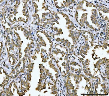 IHC staining of FFPE human lung cancer tissue with NDUFV2 antibody. HIER: boil tissue sections in pH