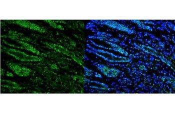 Immunofluorescent staining of FFPE human gastric cancer with RNA Helicase A antibody (green) and DAP