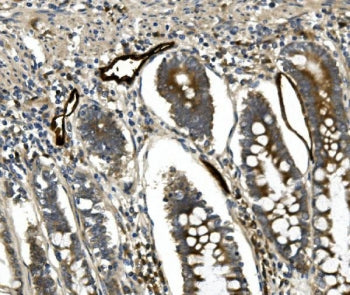 IHC staining of FFPE human rectal cancer with MADCAM1 antibody. HIER: boil tissue sections in pH8 ED