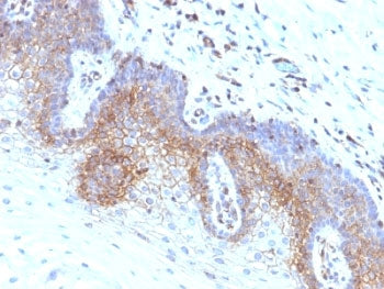 IHC: Formalin-fixed, paraffin-embedded human cervical carcinoma stained with B2M antibody (clone SPM