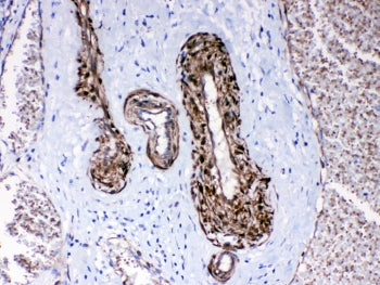 IHC testing of FFPE human lung cancer tissue with CPI-17 antibody at 1ug/ml. Required HIER: steam section in pH6 citrate buffer for 20 min and allow to cool prior to testing.
