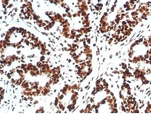 IHC staining of FFPE human colon carcinoma tissue with Ku80 antibody (clone XRCC5/7317). HIER: boil 