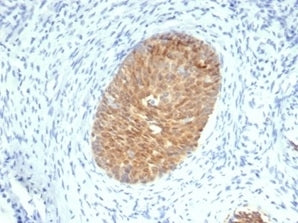IHC staining of FFPE human cervical squamous cell carcinoma with MASPIN Antibody (clone SERPINB5/497